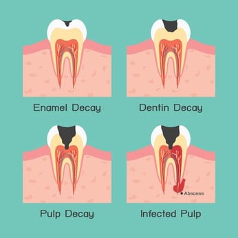 reversing tooth decay