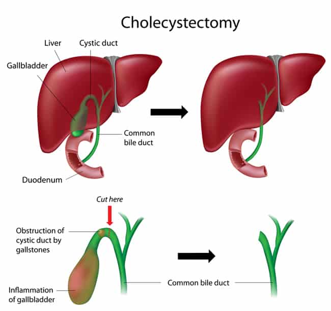 How to Cure Gallstones Naturally