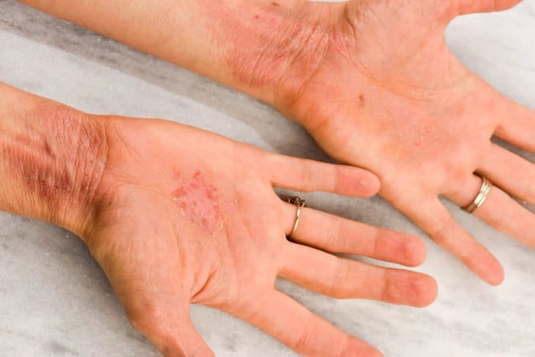 How to Get Rid of Eczema