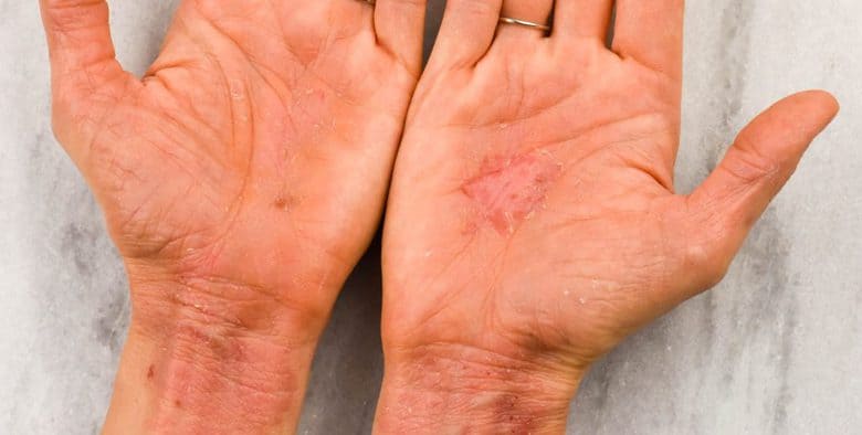 How to Get Rid of Eczema Naturally