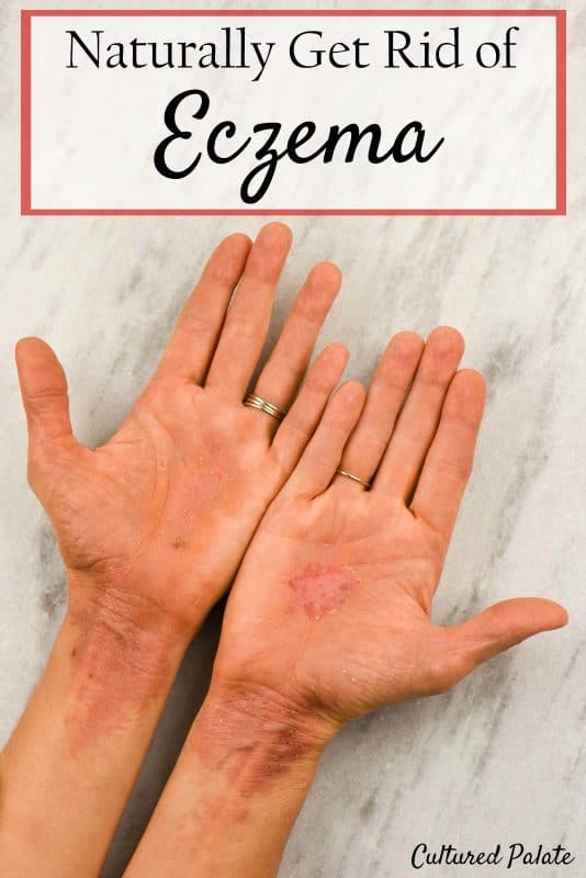 How to Get Rid of Eczema Naturally