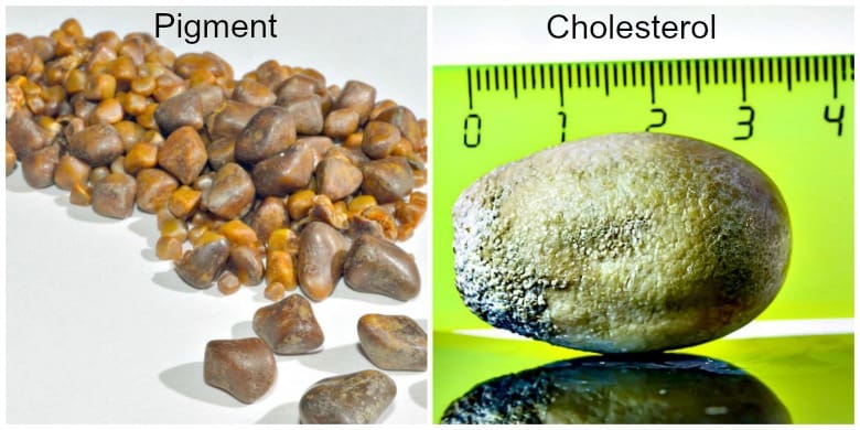 Pigment and Cholesterol gallstones shown side by side