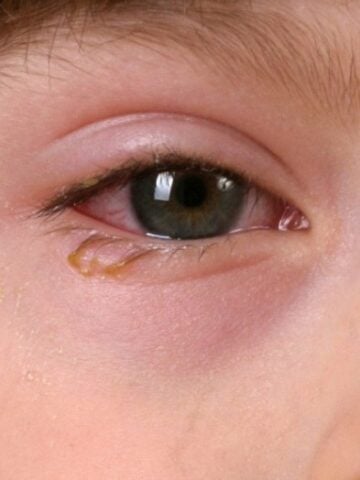 Weeping eye shown of little boy close-up/