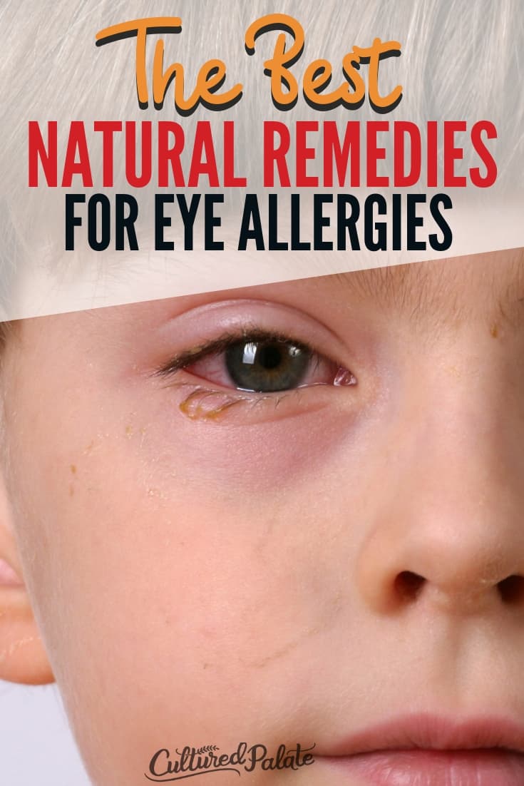 Little boy with tearing eye shown from the post Natural Remedies for Eye Allergies