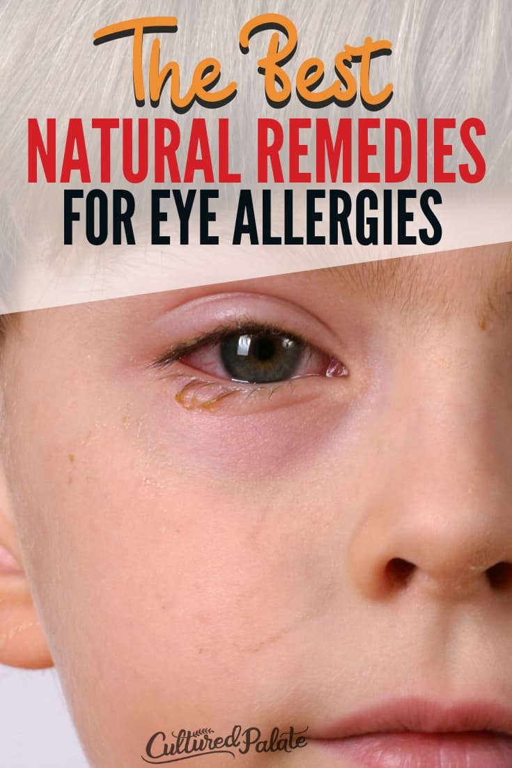 Natural Remedies for Eye Allergies Cultured Palate