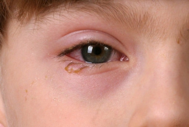 Weeping eye shown of little boy close-up/