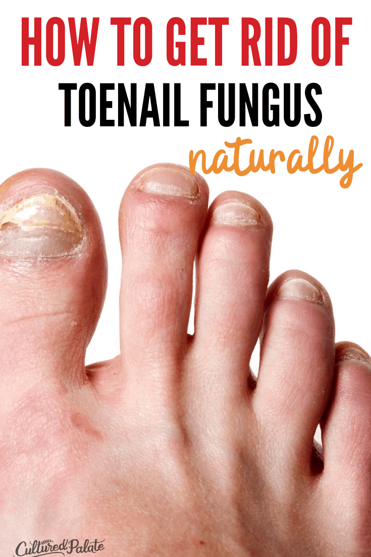 Natural Remedy For Toenail Fungus Cultured Palate