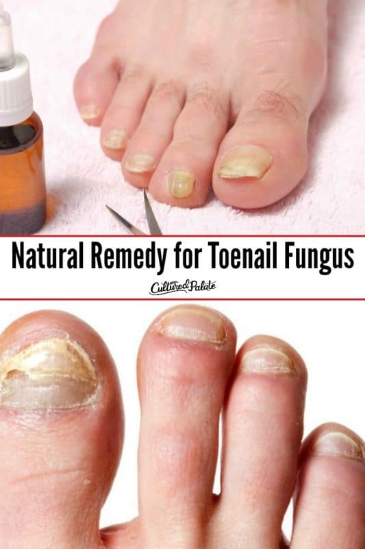 Natural Remedy for Toenail Fungus - Cultured Palate