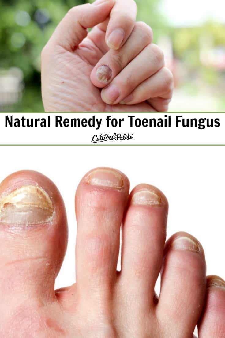 Fingernail fungus and toenail fungus shown with text overlay, 'Natural Remedy for Toenail Fungus".