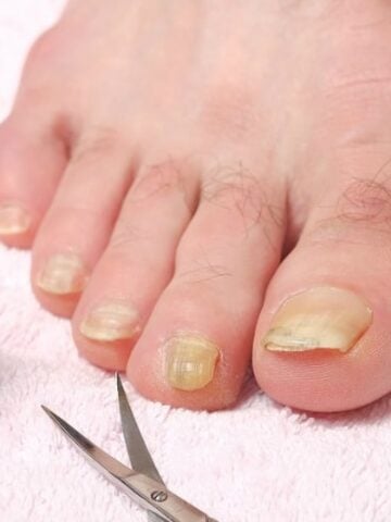 Toenail fungus shown of male foot with clippers and a bottle for Natural Remedy for Toenail Fungus